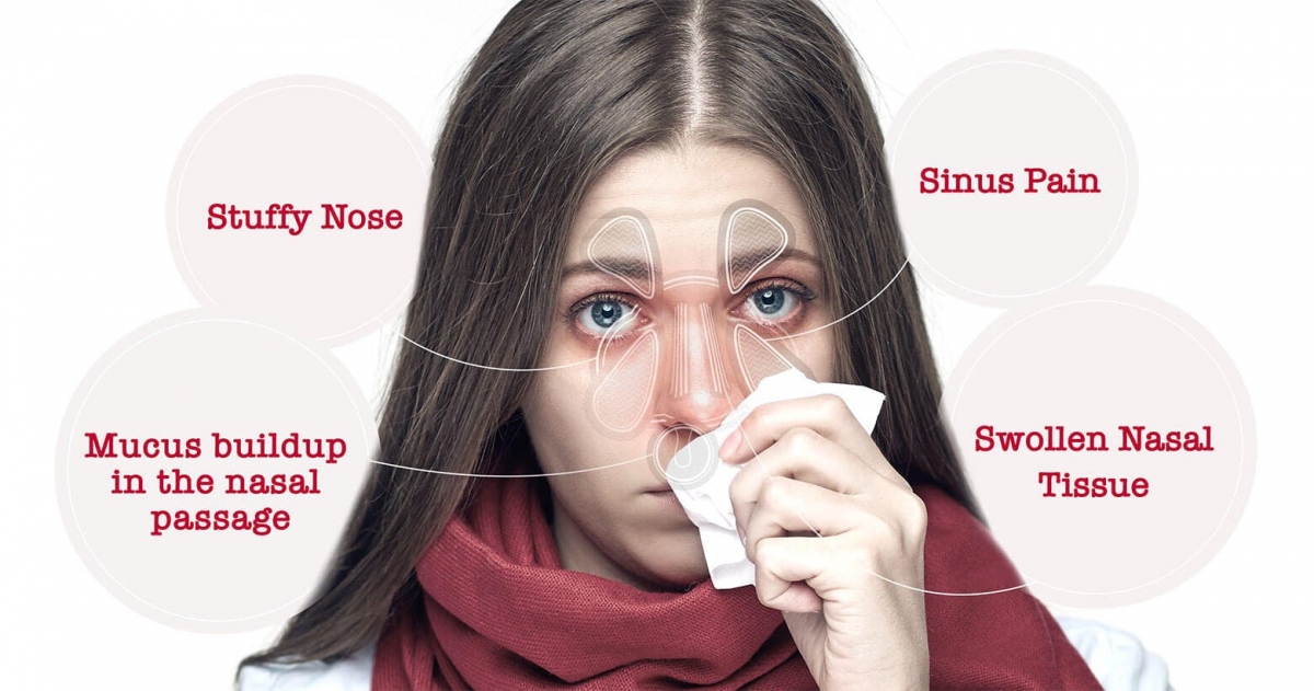 Không nên tùy tiện dùng thuốc để trị ngạt mũi